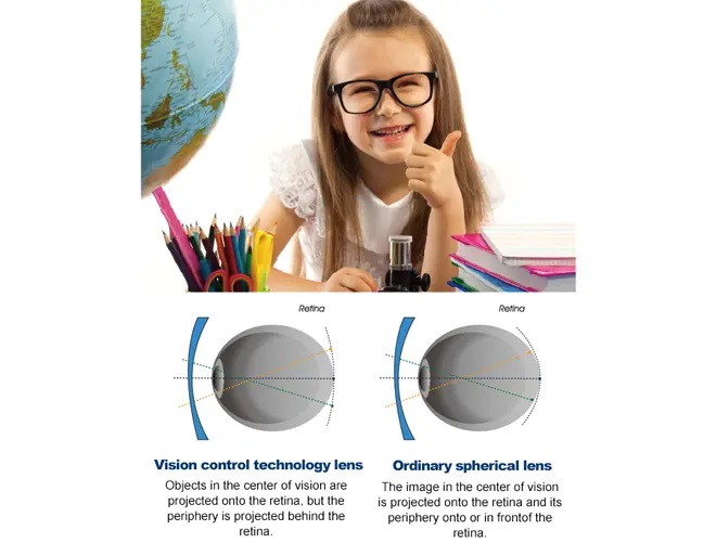 myovision-lens-2.jpg